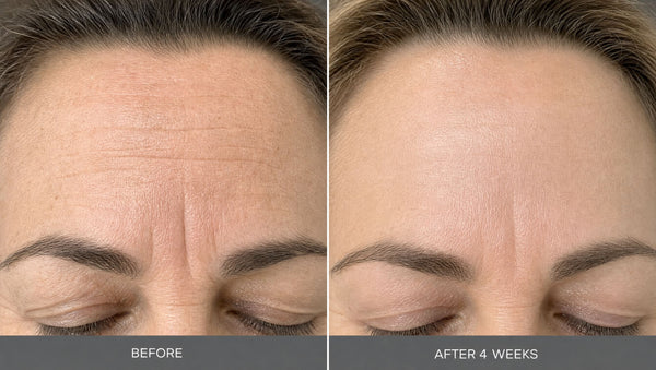 Week 2 to 3: forehead lines and 11s look softer in photos